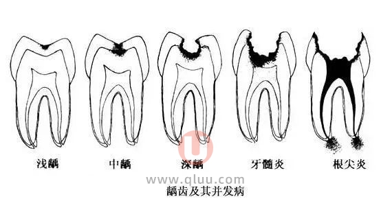 蛀牙三大阶段（浅龋中龋深龋）