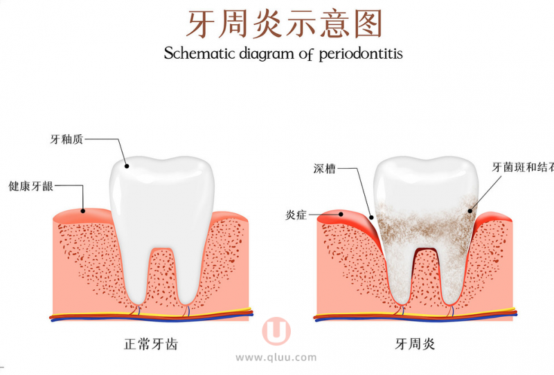 牙周炎做了种植牙会发生什么后果？