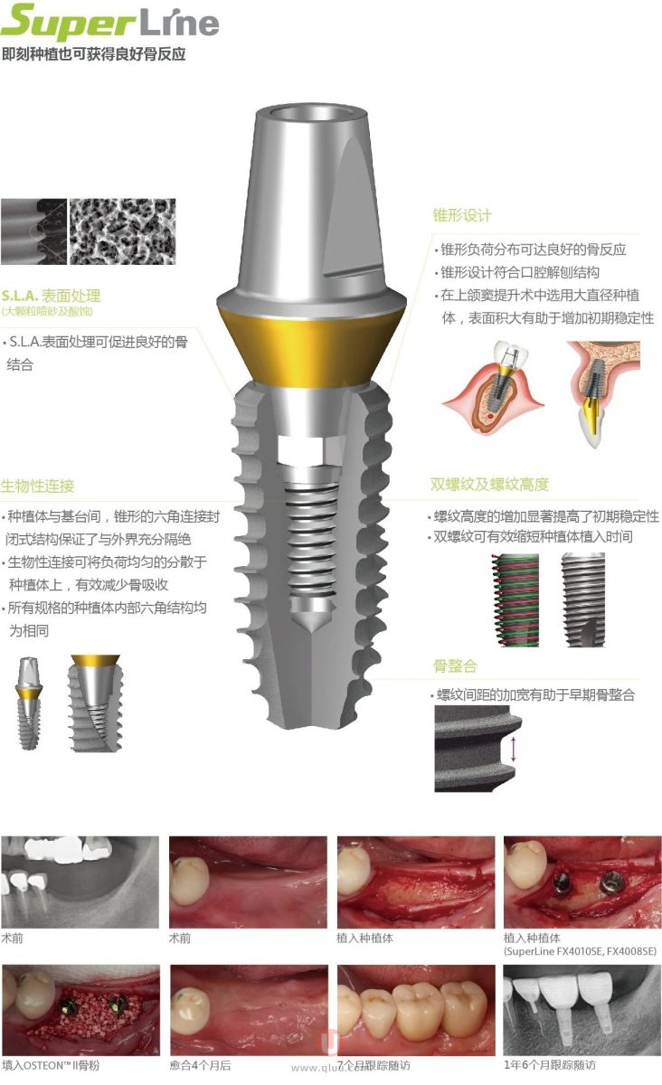 韩国登腾种植体三大型号介绍