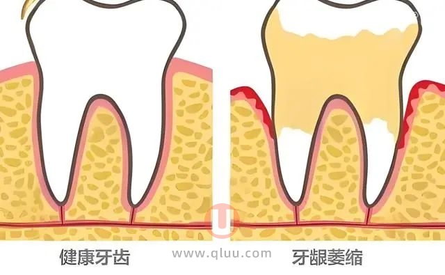 种植牙会加速牙槽骨吸收？种植牙谣言！