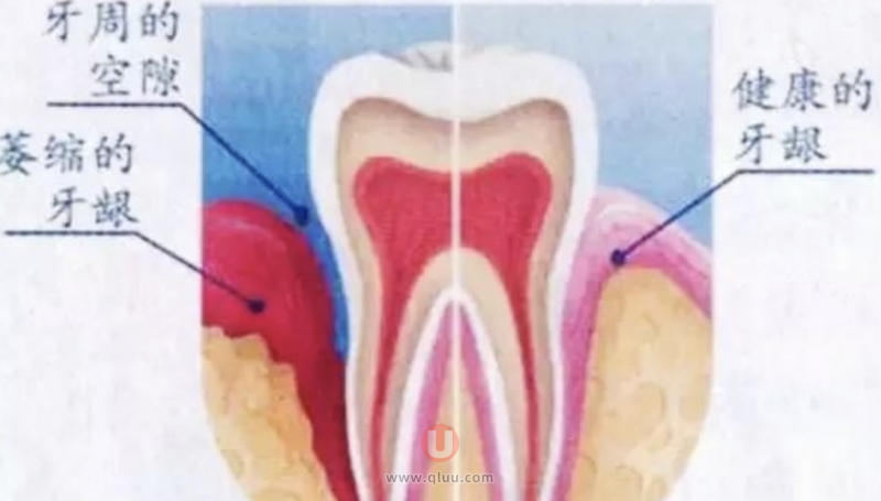 牙龈萎缩预防及缓解恢复小妙招集锦