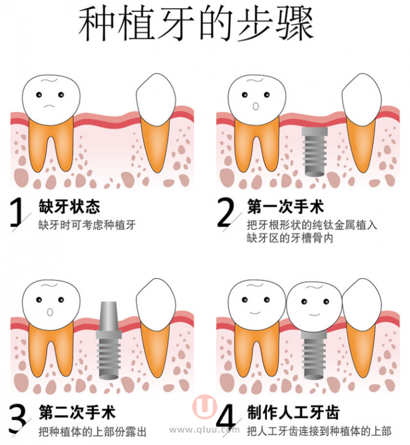 种植牙是不是假牙？和假牙比哪个更好？最新解读来了