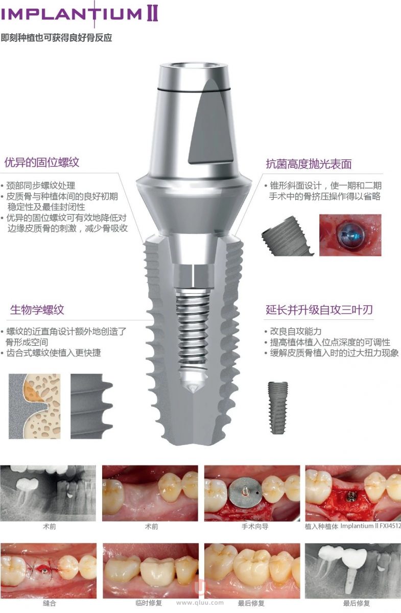 韩国登腾种植体三大型号介绍