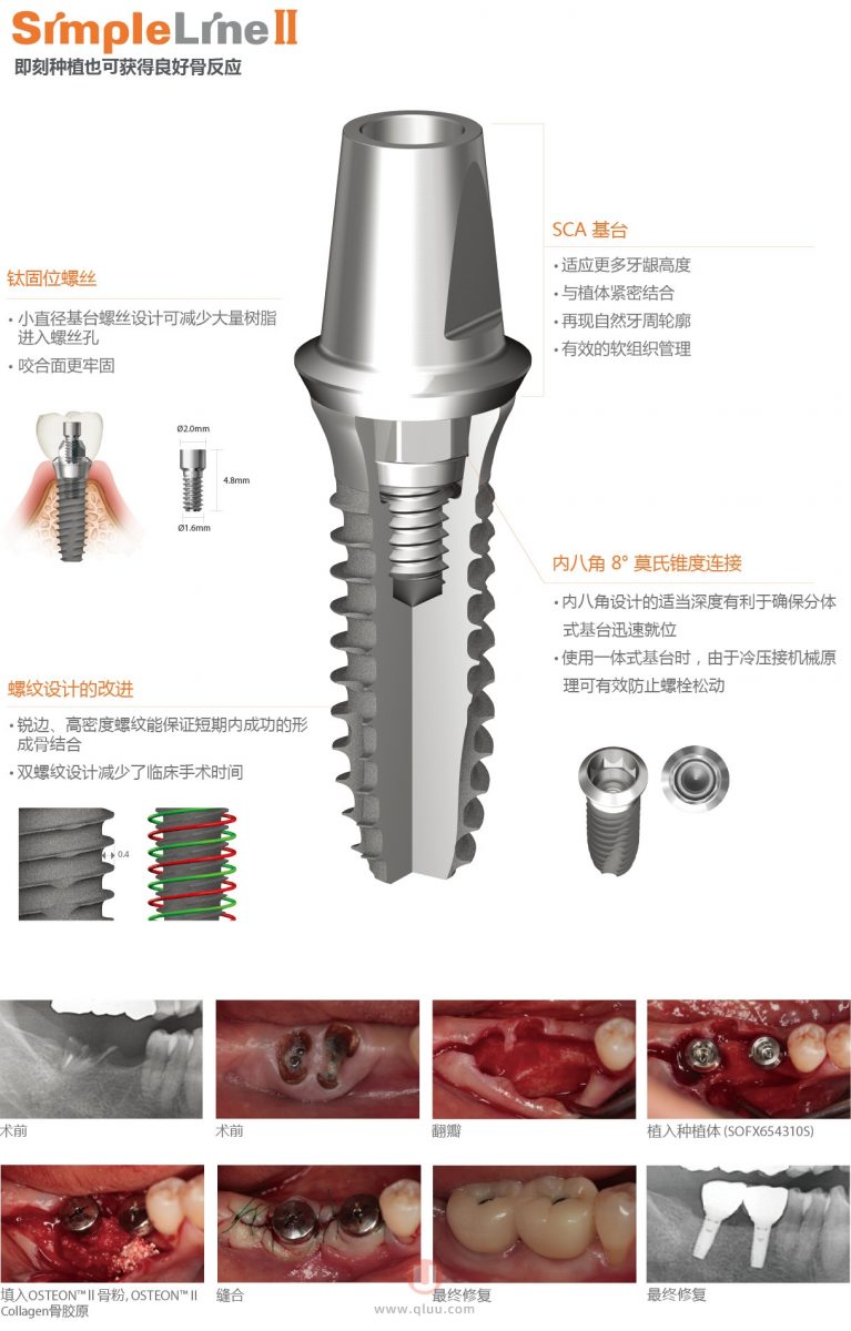 韩国登腾种植体三大型号介绍