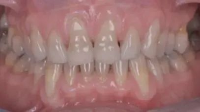 造成牙龈萎缩的最直接原因是什么？最新盘点
