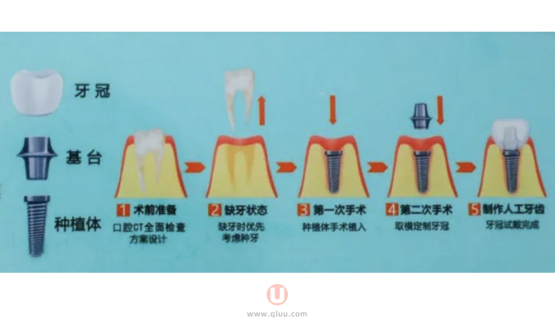 种植牙完整流程要多长时间附图片