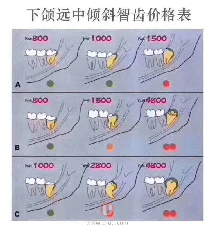 拔智齿难度系数排行榜前十名（附拔智齿最新价格表）