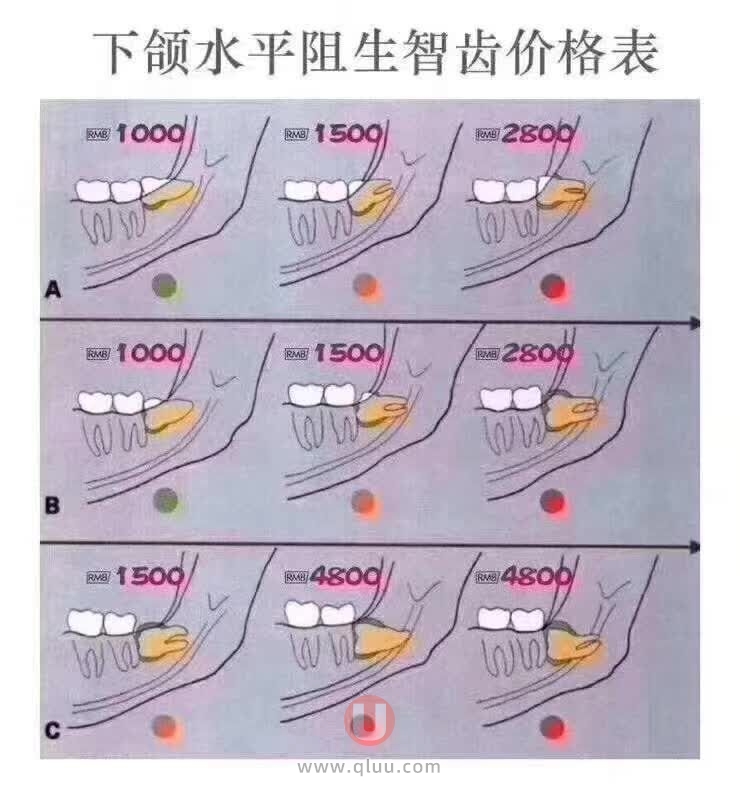 拔智齿难度系数排行榜前十名（附拔智齿最新价格表）