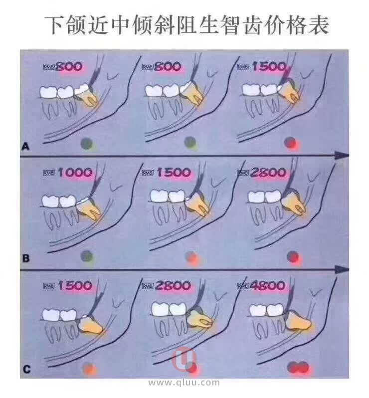 拔智齿难度系数排行榜前十名（附拔智齿最新价格表）